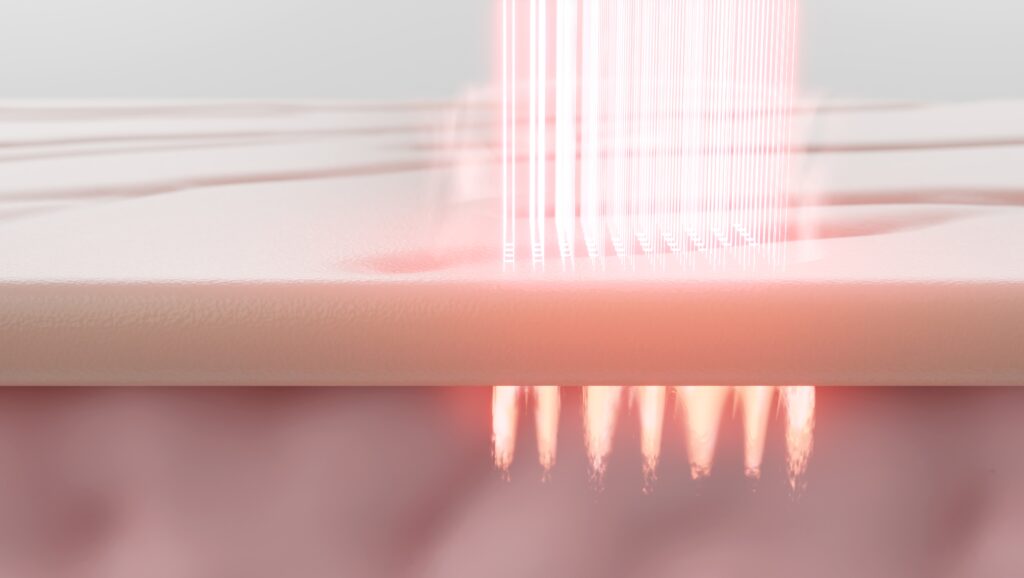 홍대피부과 울써마지는 진피층까지 에너지를 고르게 전달