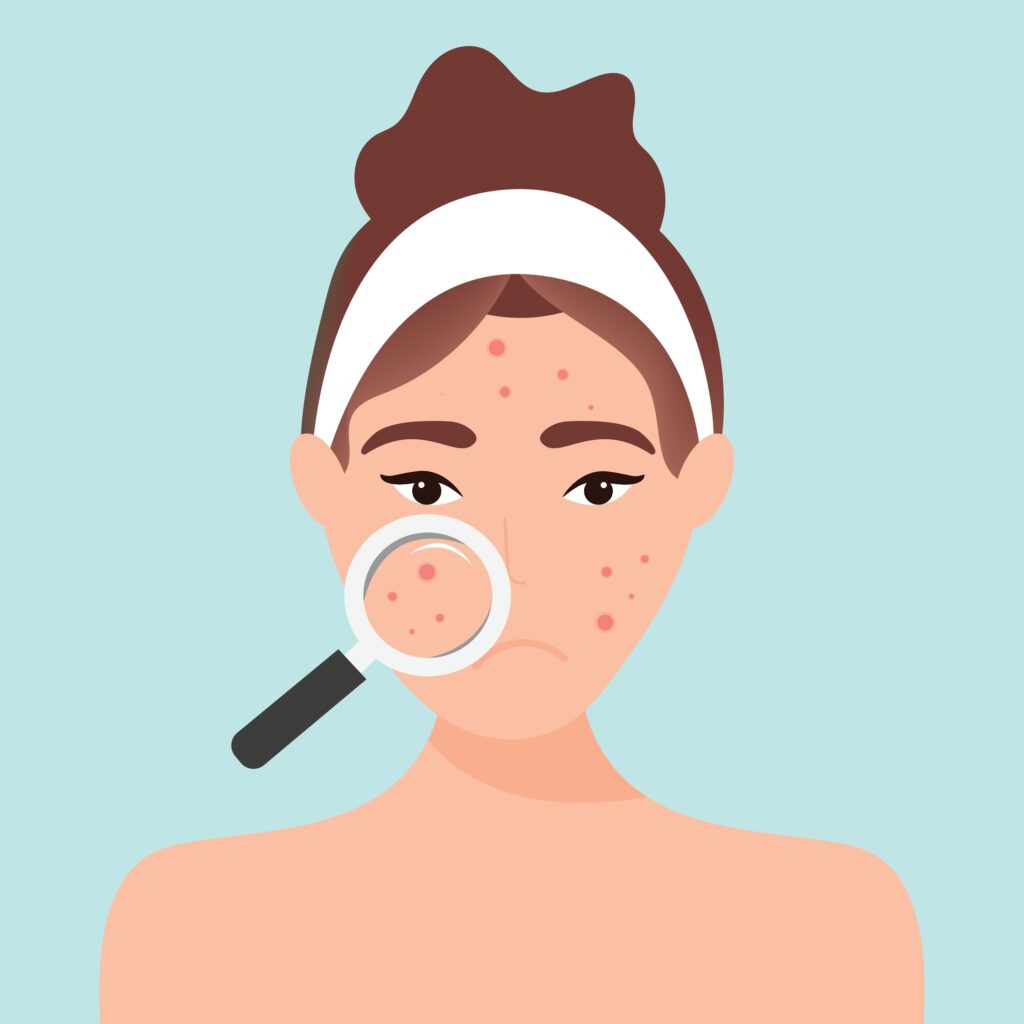 포텐다 시술 전 여드름 흉터, 모공, 피부결 고민