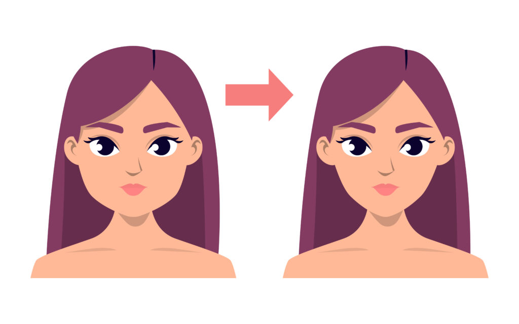 홍대 마인드피부과 사가턱 보톡스 전후 