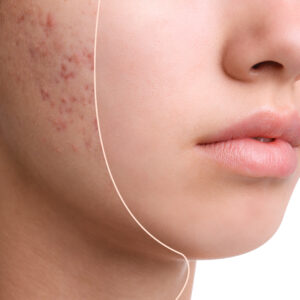 Teenage,Girl,Before,And,After,Acne,Treatment,On,White,Background,