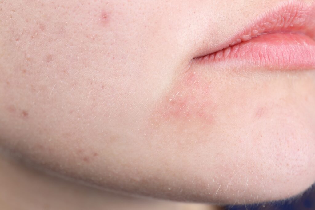 다양한 피부 고민 ( 여드름 흉터, 건조, 모공)을 가지고 있는 사람