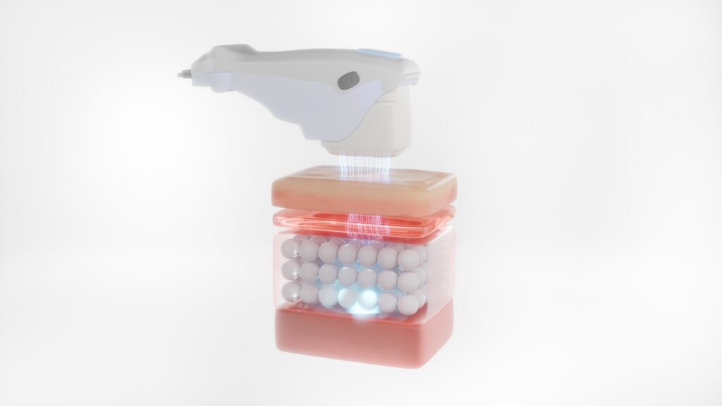 HIFU 기술을 기반으로 작용해 진피층은 물론 그 아래에 위치한 근막층(SMAS)까지 에너지를 전달하며, 콜라겐 재생을 유도