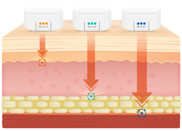 소프라노티타늄 세가지 파장의 레이저로 리프팅, 타이트닝, 화이트닝까지 한번에