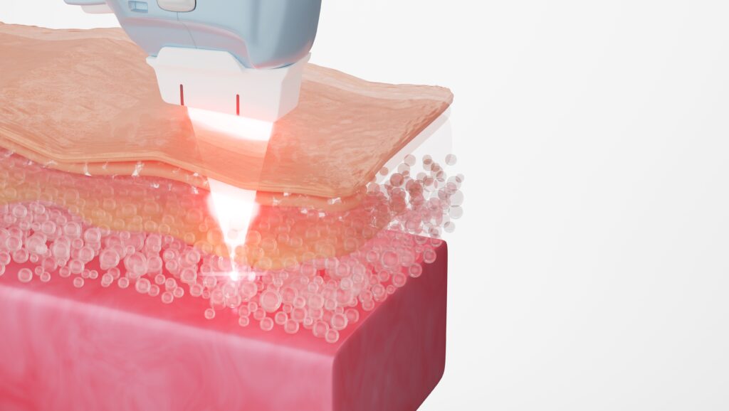 홍대 마인드피부과 리프테라는 표피층을 그대로 통과하되, 필요한 반응이 일어나야 하는 지점에 도달하도록 조절되는 구조