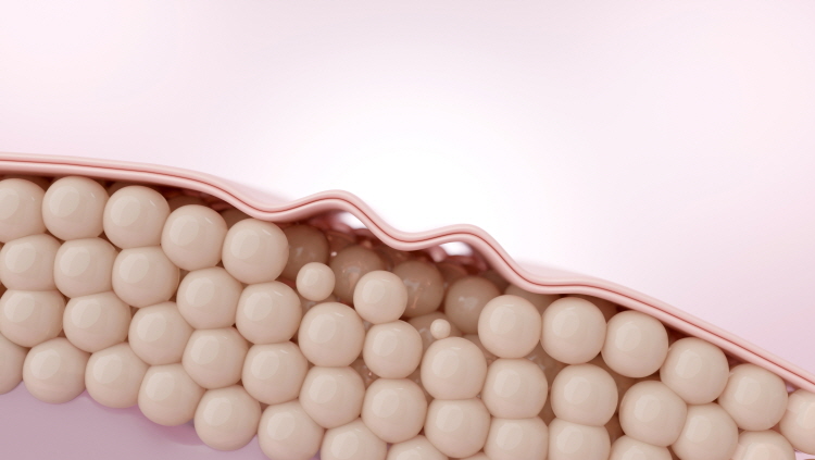 콜라겐과 히알루론산이 감소하면서 피부 속 밀도가 떨어진다.