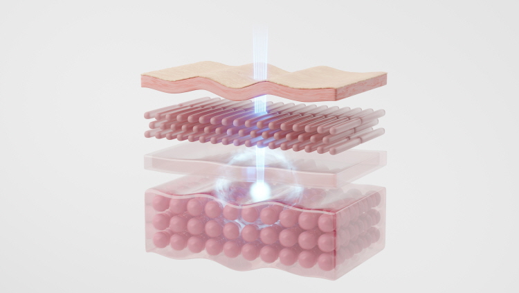홍대 마인드피부과 온다리프팅 시술 과정