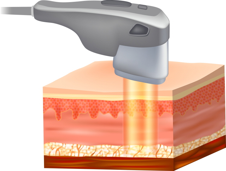 홍대울쎄라는 고강도집속초음파(HIFU)를 활용해 피부 속 특정 깊이에 에너지를 전달하는 구조입니다.