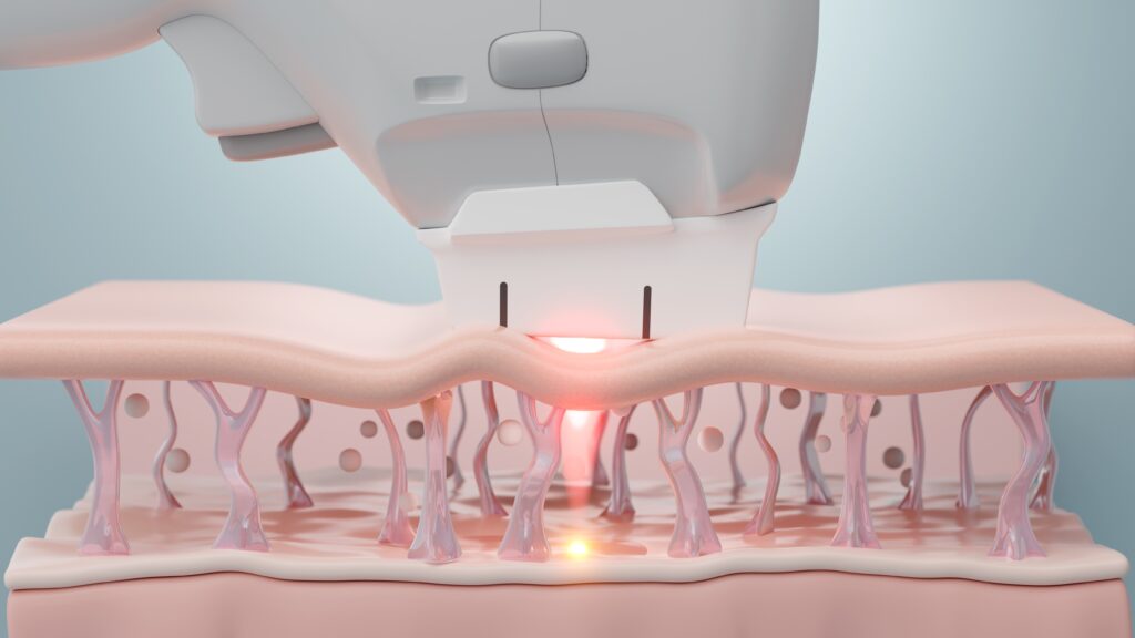 홍대울쎄라는 시술 직후 눈에 띄는 변화보다는, 시간이 지나면서 피부가 점차탄탄해지는 방향
