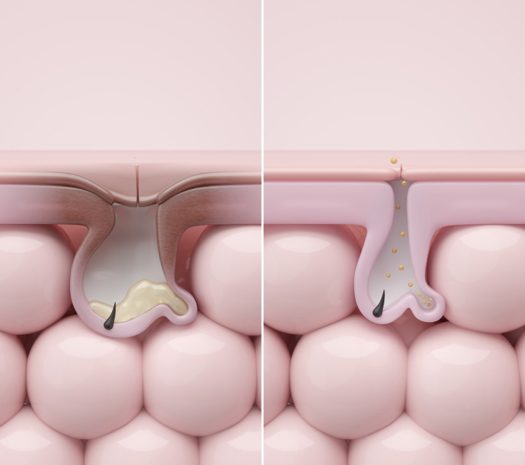 홍대 마인드피부과 엑소좀은 세포 간 신호 전달에 관여하는 물질로 피부가 회복 과정에 들어갈 수 있는 환경을 만들고, 그 과정에서 세포 간 소통이 원활하게 이루어지도록 돕는 개념이다